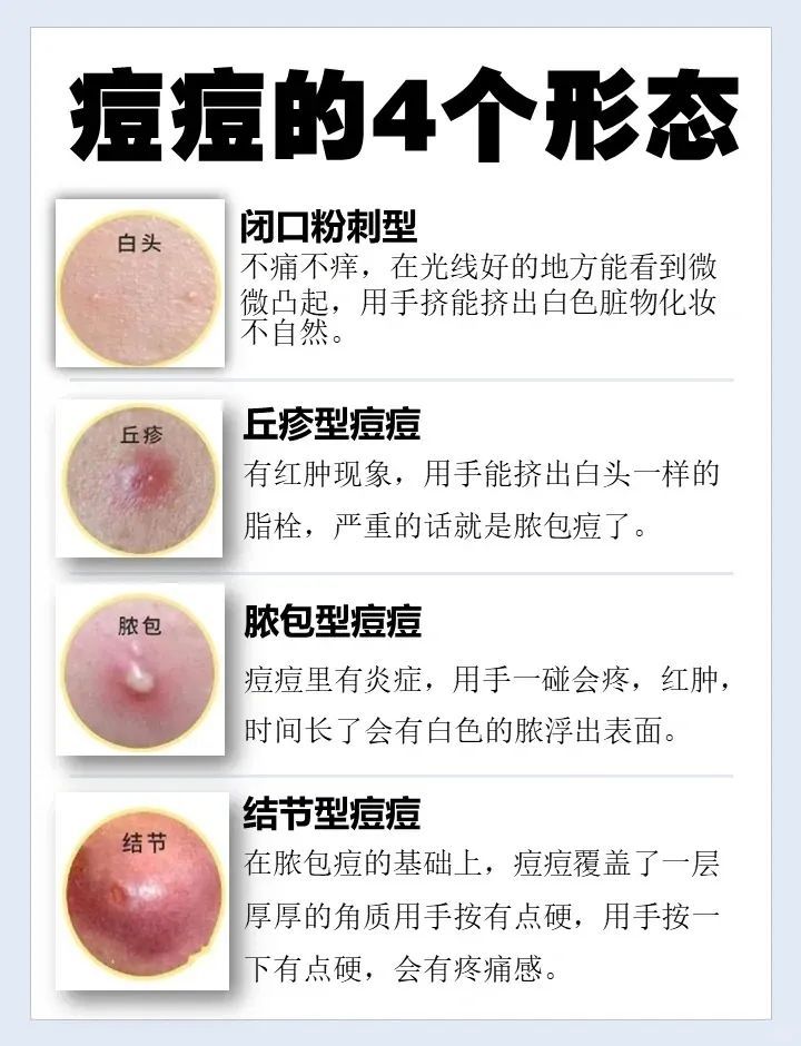 怎么判断脸上痘痘类型